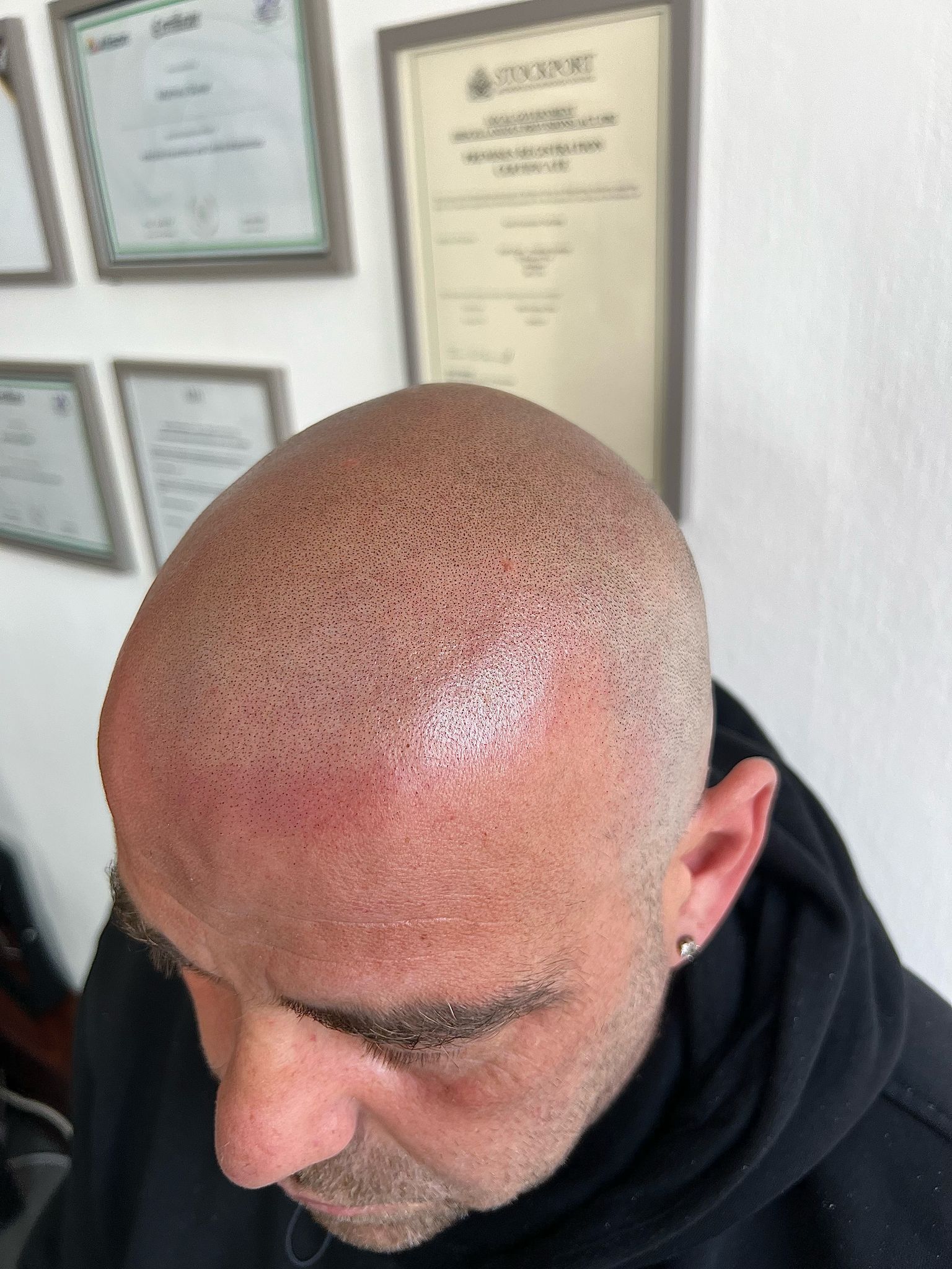 After SMP Hairline