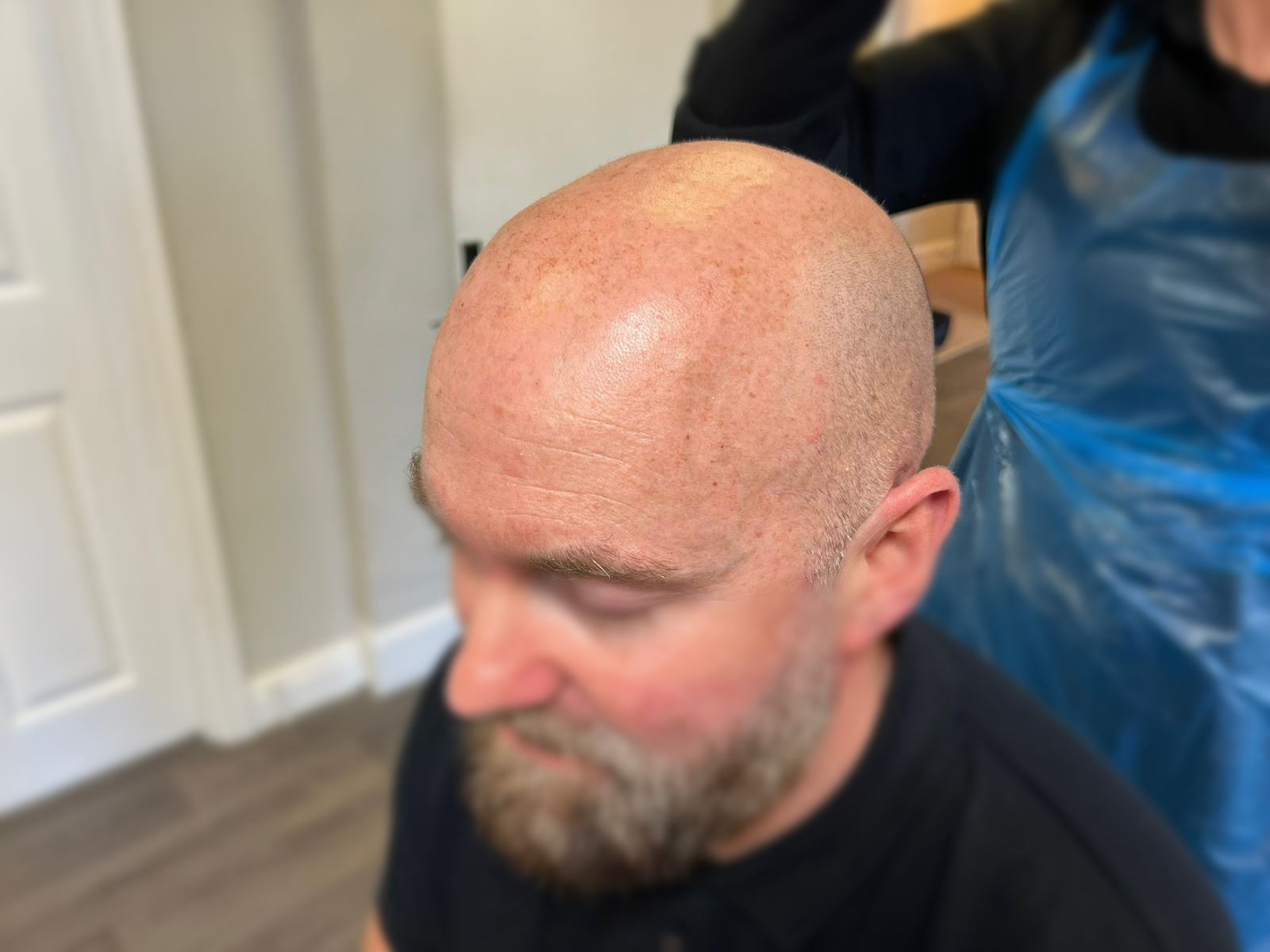 Before SMP - Side Profile